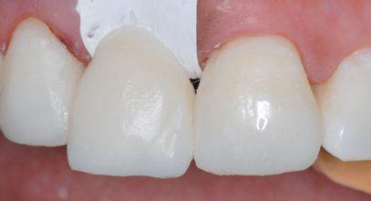 from the mesial of the lateral incisor to