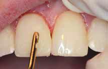 Aluminum-oxide points should be used to create labial grooves in veneers, to finish and polish occlusal surfaces of posterior