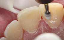 When used with pressure, the coarse disc makes it easy to blend the composite into the tooth surface, eliminating the white