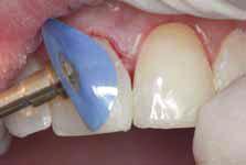 A larger-grit (45-µm strip) should be used for interproximal stripping of natural teeth or for gross removal of material, and