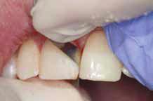 from restorative material to tooth surface, similar to burnishing metal. This can be done in a wet or dry field.