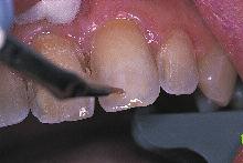 Using pink opaque before applying the composite restorative material neutralizes gray tetracycline stains and