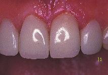 Pink opaque is also effective in repairing the dark gingival discoloration often seen with porcelain and metal restorations. I R E NA M E L A MUST FOR R EFERENCES 1. 2.
