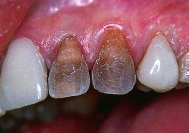 N EW PINK OPAQUE TREATS THE DARKLY STAINED DENTITION RELIABLY AND WITH NATURAL RESULTS.