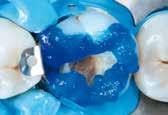 advantages. Following light-curing, all that remains is to apply an occlusal covering layer.