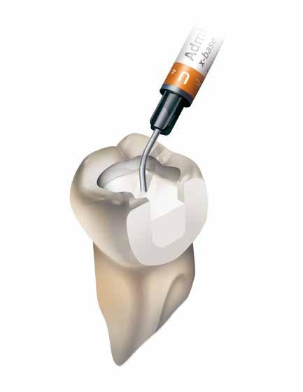 Admira Fusion x-base Admira Fusion x-base NANO-HYBRID ORMOCER RESTORATIVE MATERIAL Indications Base in class I and II cavities Cavity lining under direct restorative materials in class I and II