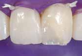 Admira Fusion a guarantor for restorations which are aesthetic and remain intact for a long time.