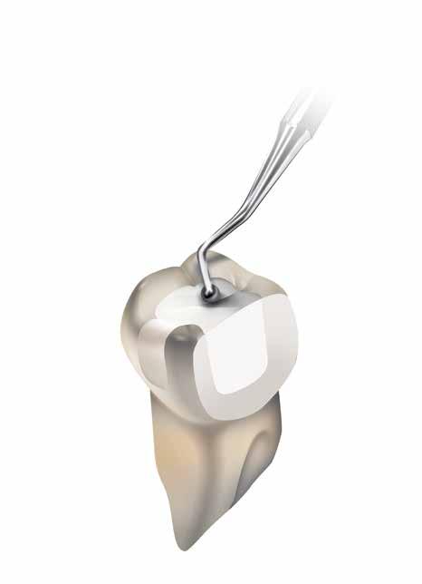 Admira Fusion x-tra Admira Fusion x-tra Nano-hybrid ORMOCER restorative material Indications Class I and II posterior restorations Base in class I and II cavities Class V restorations Locking,
