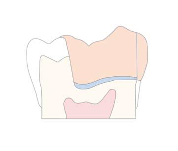 Indications Restoration of - minimally invasive anterior and posterior cavities - Class I through