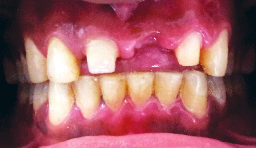 IJOPRD TREATMENT The abutment teeth 11 was root canal treated (evident on IOPA radiograph) and 22 was vital with no signs