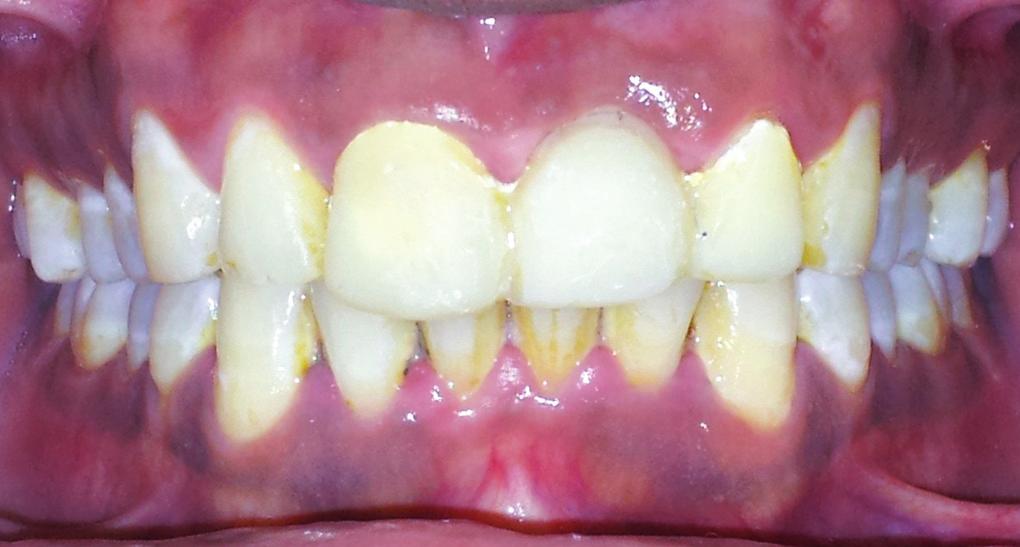 7 Patient was recalled every 1 week and the contour of the gingival surface was modified by adding 1 mm composite resin in