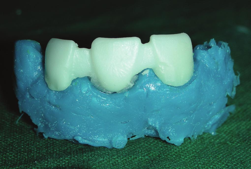 The final framework was seated on this cast and gingival surface was relined with selfpolymerizing acrylic resin (Fig. 10).