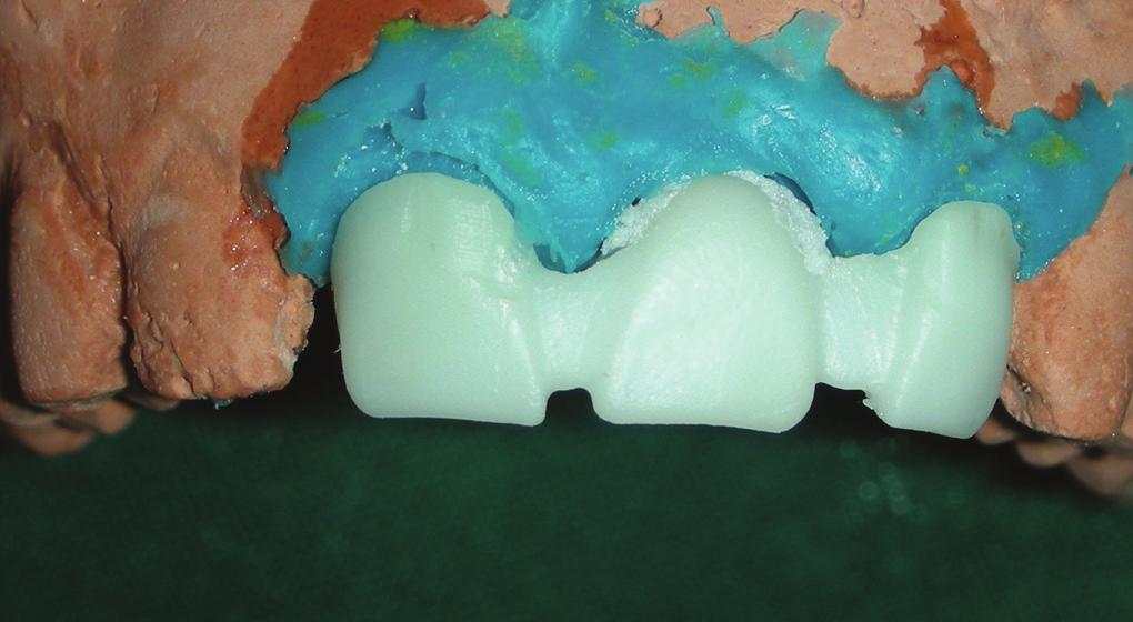 The cast was now poured with Silicone and type IV dental stone over which the final prosthesis will be fabricated (Fig. 11).