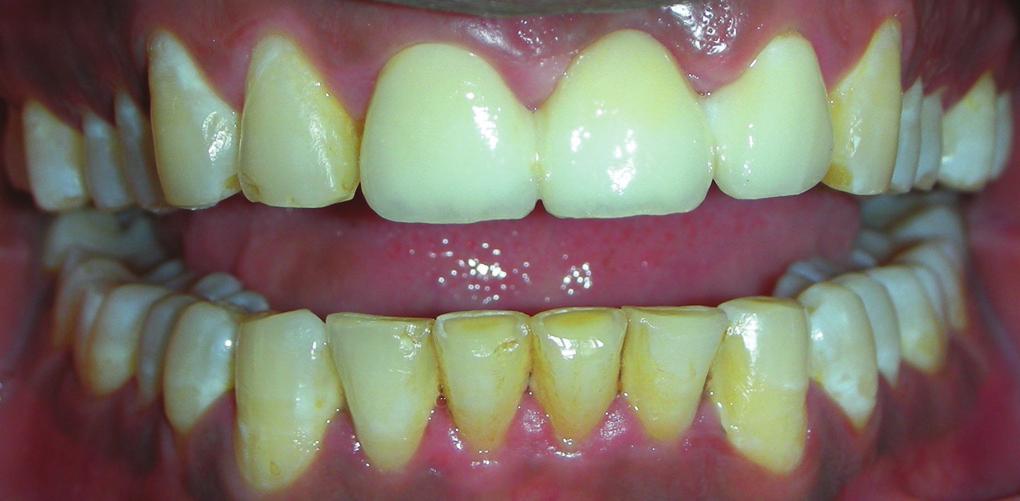 A Zirconia CAD-CAM based prosthesis was used to address the esthetic needs of the patient and also have adequate strength ensuring longevity of the prosthesis. CONCLUSION Fig.