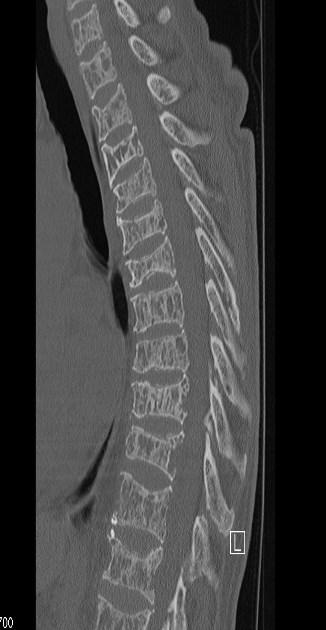 Spine Imaging in Malignancy Plain films Poor sensitivity as screen for bone metastasis (at least 30% loss of bone density needed to see lytic lesion) Can evaluate mechanical alignment of vertebra and