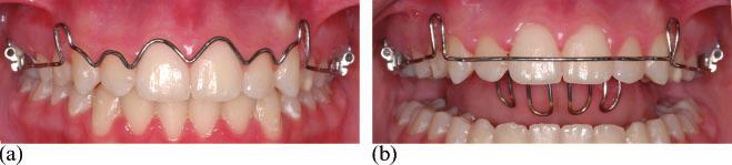 JO September 2012 Clinical Section Skeletal class III and open bite: case report 213 Figure 1 Conventional wraparound retainer with a tongue grid (a) and modified retainer adapted at the