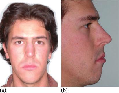 23-year-old man showed an accentuated vertical facial pattern, a class 3 facial profile and the absence of a lip seal during rest (Figure 3).