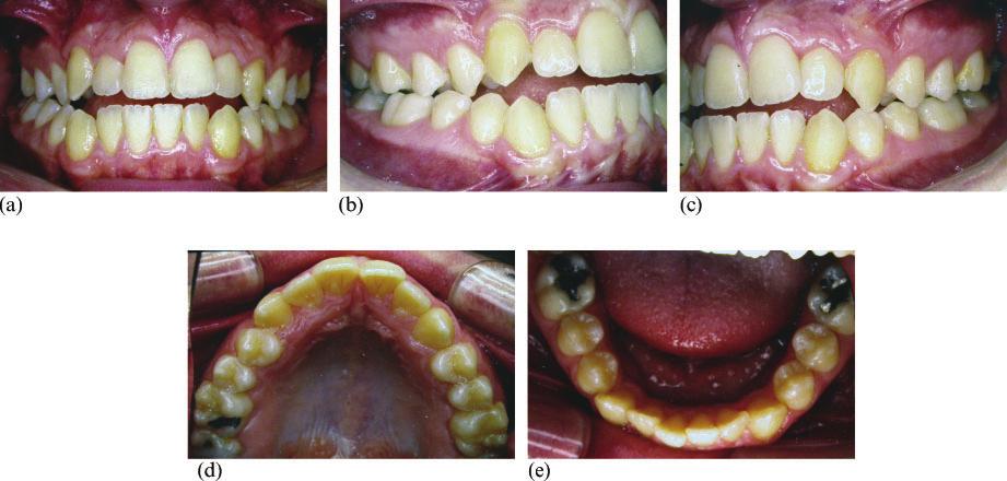 JO September 2012 Clinical Section Skeletal class III and open bite: case report 217 Figure 10 occlusal Case 2 pre-treatment intra-oral photographs: (a) frontal, (b) right side, (c) left side, (d)