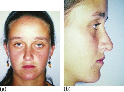 total superposition showed the patient had increased vertical growth of the face and a marked clockwise rotation of the mandible.