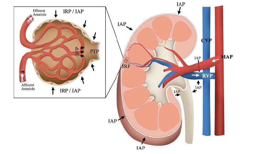 Effect of venous congestion and intra-abdominal pressure on renal function Increase tubular hydrostatic pressure opposes filtration