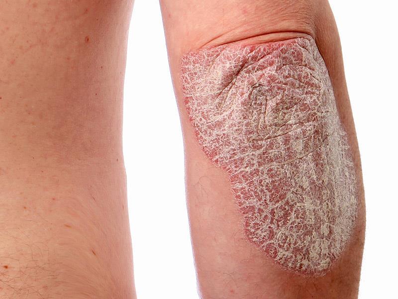 Pathology of psoriasis Inflammatory cell infiltration