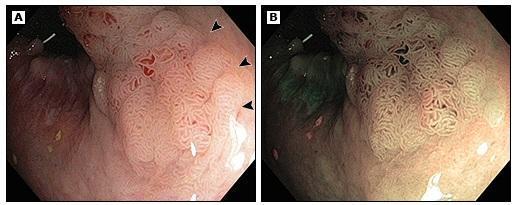 e > 2 cm Large colon polyps Endoscopic mucosal resection Used for large flat and sessile polyps Clearly define the borders both white light and NBI evaluation Large