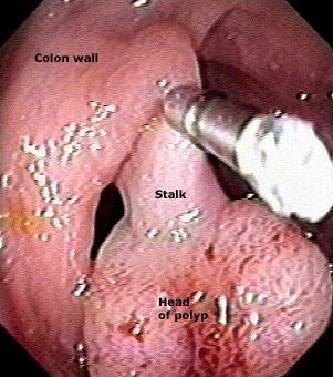 Large colon polyps Endoscopic mucosal resection Preventing risk of bleeding after resection Epinephrine injection at polypectomy site Placement of