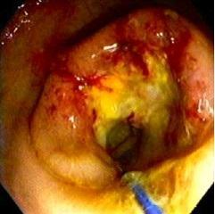 complete obstruction (without signs of toxicity) Colonic stenting Technique Patients generally prepped with enemas Mass attempted to be passed with the