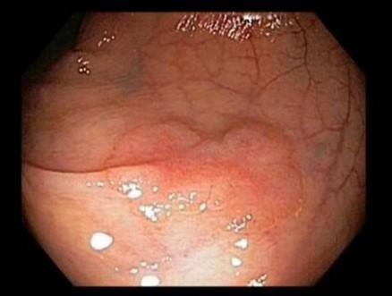 Colon cancer surveillance Serrated lesions Difficult to detect at colonoscopy Similar color as surrounding mucosa Indiscrete edges Often flat Often adherent mucous layer/cap Colon cancer