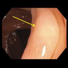 interval (years) Quality of evidence supporting the recommendation Sessile serrated polyp(s) <10 mm without dysplasia 5 Low Sessile serrated polyp(s) 10 mm 3 Low Sessile serrated polyp with