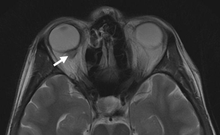 El-Sawy et al. 39 Figure 6. Axial T2-weighted MRI of patient 3 demonstrating a mass medial to the optic nerve and just posterior to the globe on the right side (white arrow).