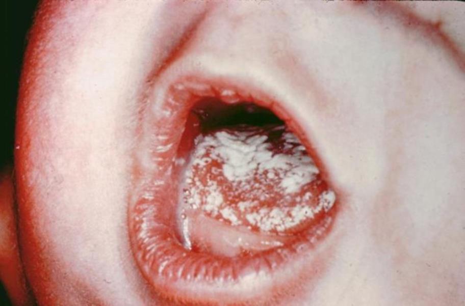 Candidiasis Candidiasis: fungal infections caused by Candida, ex: Oral candidiasis (Oral thrush): Infection of the mouth surface Very