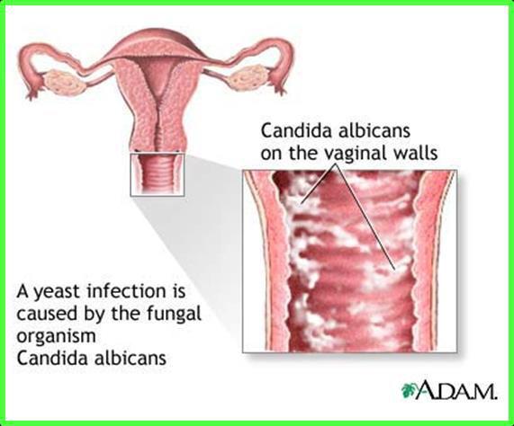 3- Vaginal candidiasis (Vaginitis): Infection of vaginal mucosa by candida.