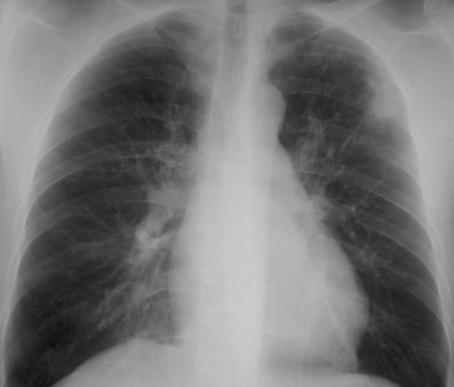 CXR: LUL nodular infiltrate, slight volume loss, maybe slightly worse since prior film What is your estimate of the likelihood of active TB in this case? 1. 75% or higher 2. 50-75% 3. 25-50% 4.