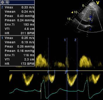 Mean right atrial pressure (hepatic venous flow) Systolic filling fraction: SFF = VTI S /