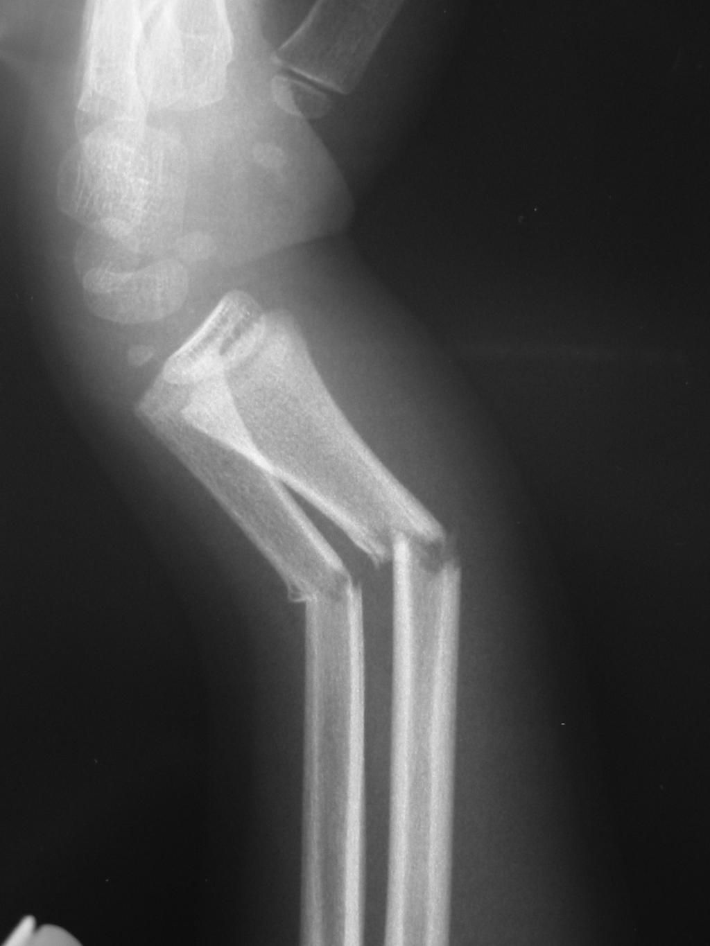 COMMON PAEDIATRIC ORTHOPAEDIC PROBLEMS AND FRACTURES 8.1 usually require accurate reduction and internal fixation to minimize the risk of growth arrest.