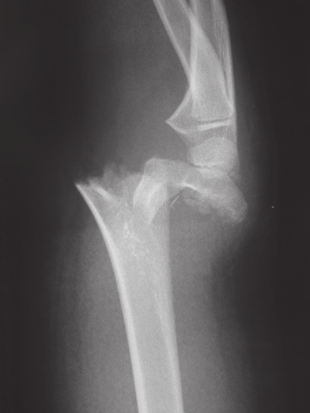 8.1 COMMON ORTHOPAEDIC PROBLEMS A Fig. 8.1.18 A Supracondylar fracture of the humerus may have a nerve injury. B Displaced fractures require reduction and K-wire fi xa t i o n.