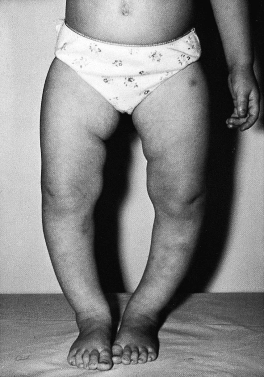 This is the tiptoe test, which also demonstrates development of the medial longitudinal arch (Fig. 8.1.4). 250 Fig. 8.1.2 Bow legs in a toddler: a normal phenomenon.