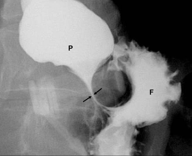 Imaging after bariatric surgery for morbid obesity 293 tered orally to confirm adequate narrowing of the stoma without obstruction (Fig. 13).
