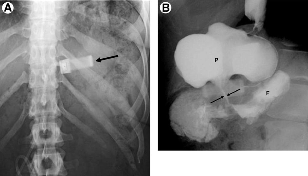 294 L.R. Carucci and M.A. Turner Figure 15 LAGB: Eccentric pouch dilatation because of band slippage. (A) A supine radiograph shows an inferiorly located band with a horizontal configuration (arrow).