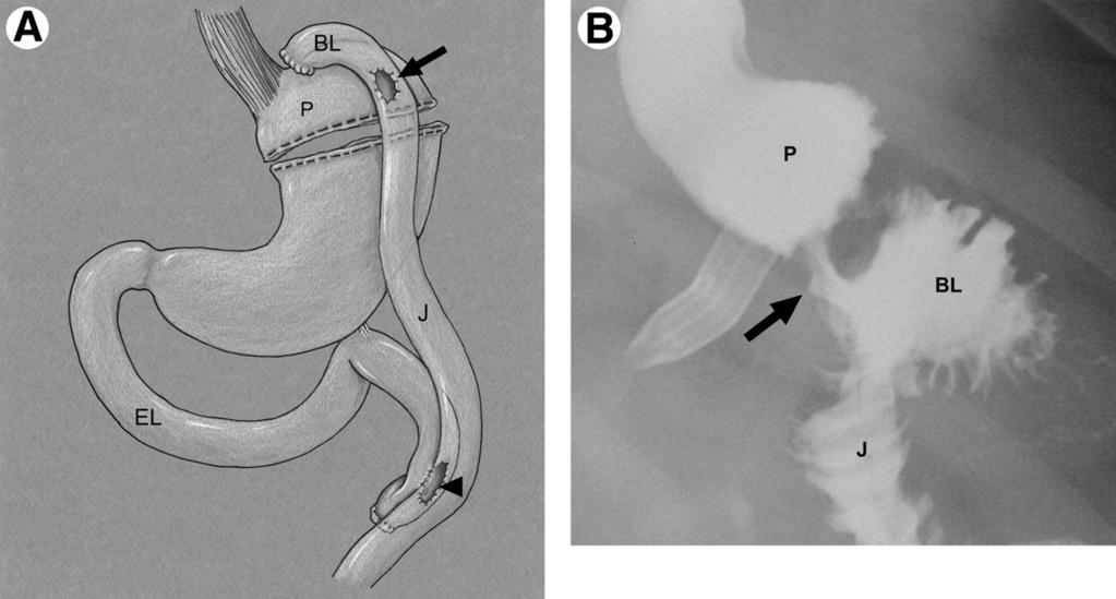 284 L.R. Carucci and M.A. Turner Figure 1 RYGB: Expected postoperative anatomy.