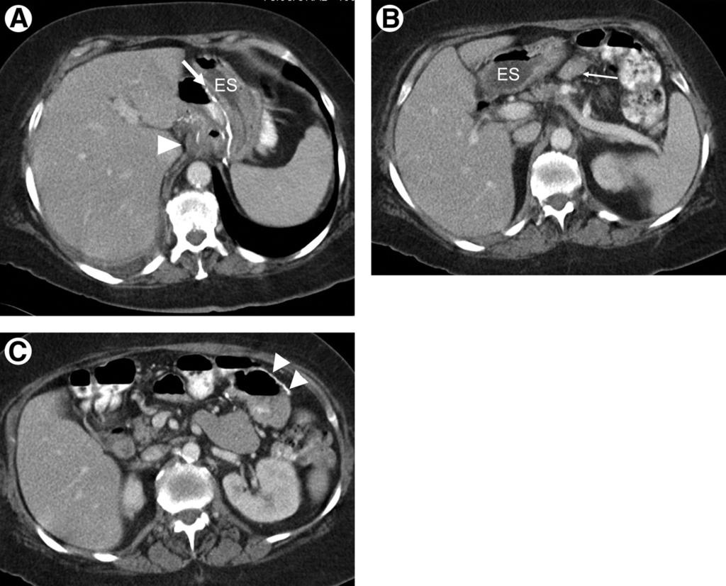 Imaging after bariatric surgery for morbid obesity 285 Figure 2 RYGB: Postoperative anatomy on CT.