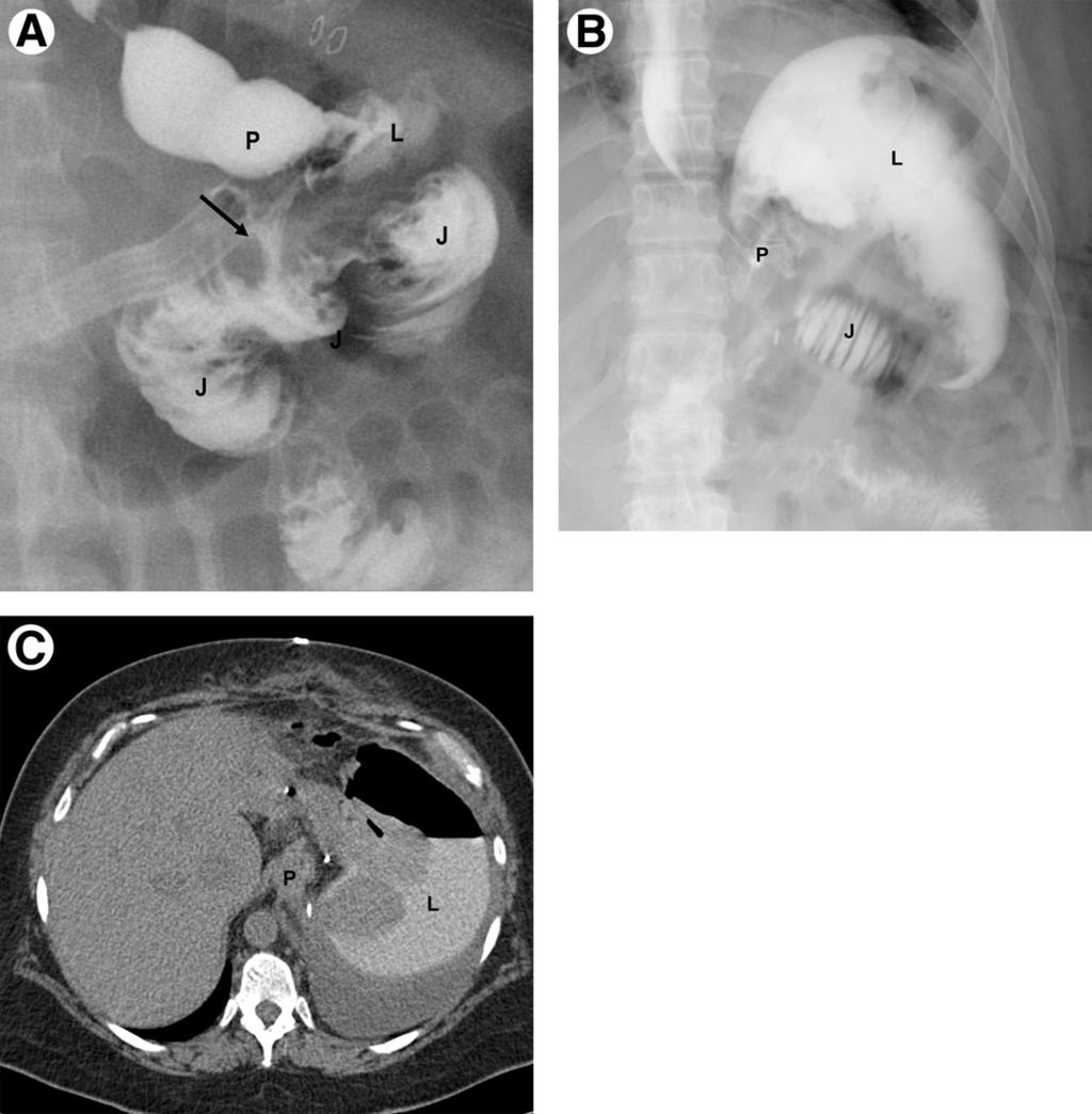 286 L.R. Carucci and M.A. Turner Figure 3 RYGB: Postoperative leak in 3 different patients.