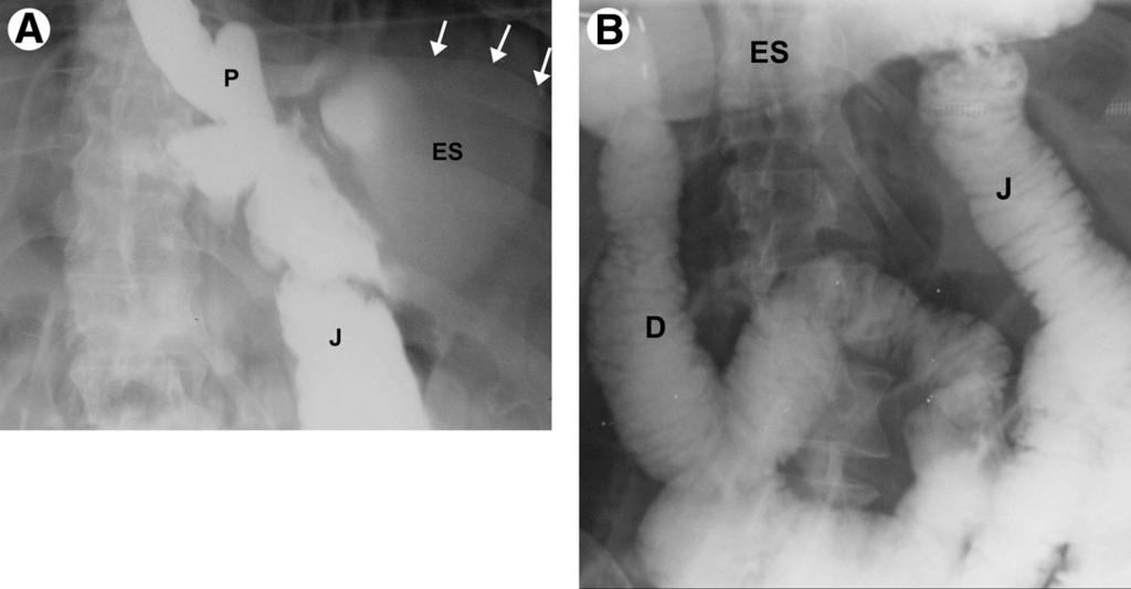 2,23,24 Late SBO may be due to adhesions, IH, abdominal wall hernia, and rarely intussusception. After open surgery, adhesions are the most common cause of SBO.