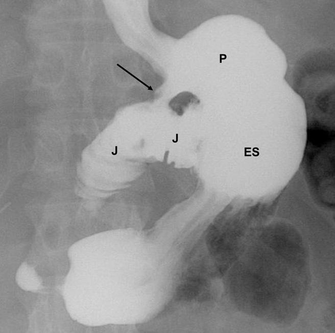 288 L.R. Carucci and M.A. Turner of IH include clustered bowel displacing other bowel, small bowel limbs entering and exiting the clustered segment, and stasis in clustered bowel 22,27 (Fig. 8).