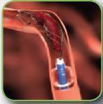 Endovascular Therapy (EVT) EVT is an image guided procedure for