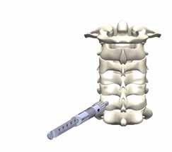 The same steps can be followed to insert the screw inside the lateral masses. A combined approach is also possible according to the surgeon s needs.