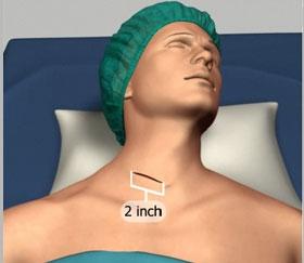 Surgical Procedure The neck muscles are separated and the esophagus and trachea are retracted
