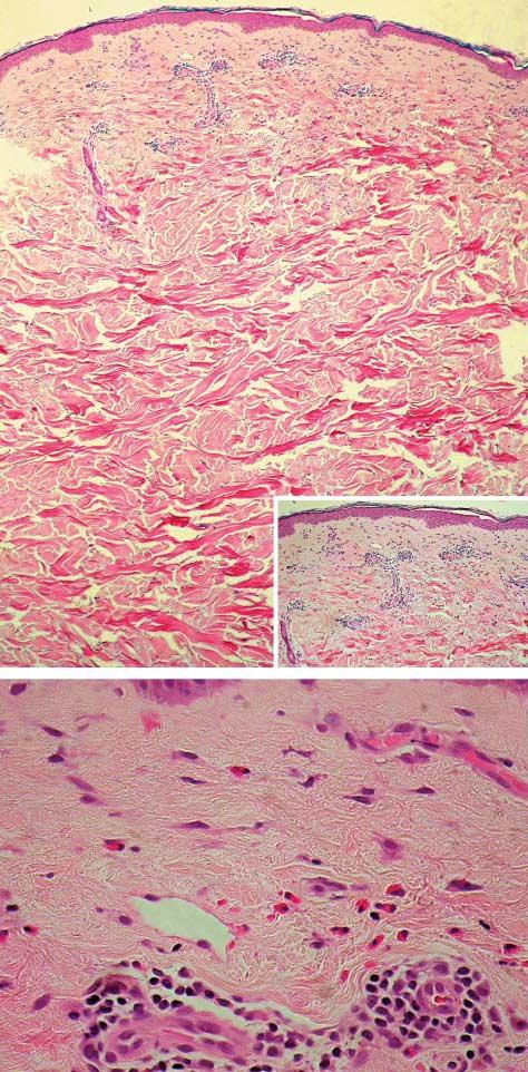 A B Figure 1. Histopathological features of urticarial dermatitis. A, Slight epidermal spongiosis with superficial perivascular lymphocytes and interstitial eosinophils (original magnification 100).