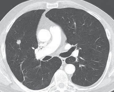 screening trials performed to date also detected a high number of pulmonary nodules [4, 5].